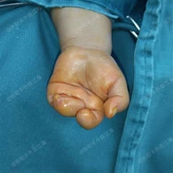 Chirurgie du syndrome de la bande amniotique