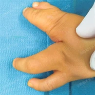 Chirurgie de la fente main