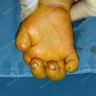 Chirurgie des contractures de flexion