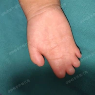 Chirurgie de la syndactylie du syndrome de Pologne